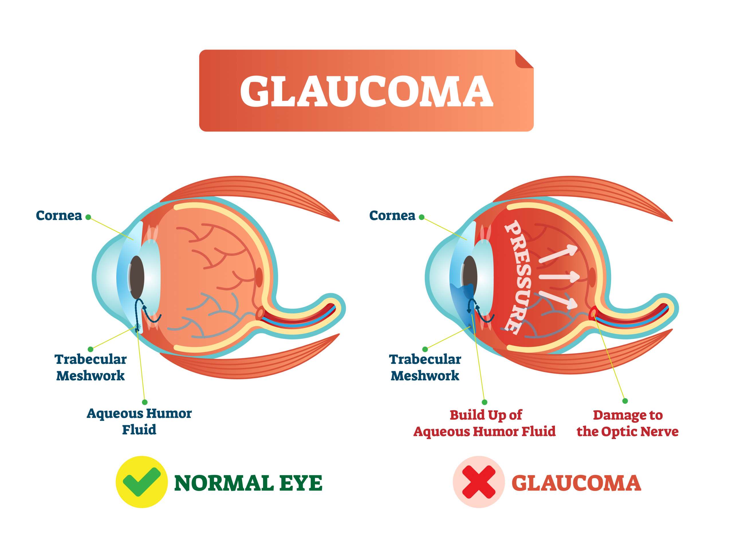 treatment for glaucoma